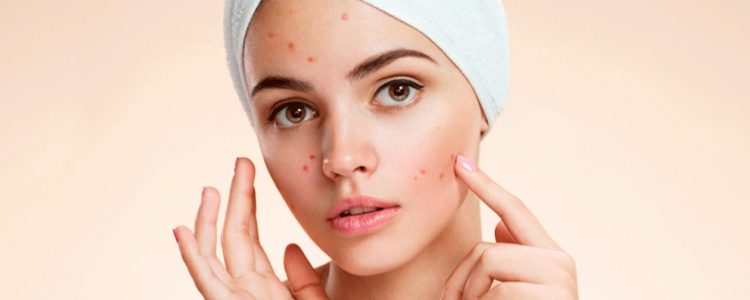 Acne – Principais cuidados para uma pele livre de acnes
