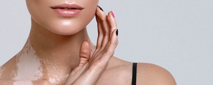 Vitiligo – Entenda suas principais causas e formas de tratamento.