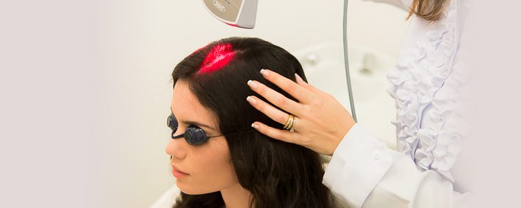 Laser capilar: tratamento para calvície