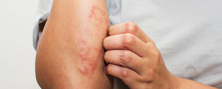 Dermatite atópica: causas e sintomas